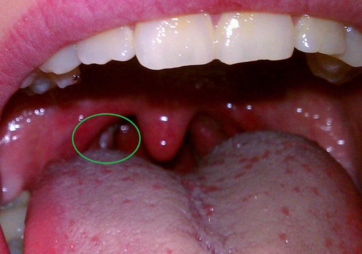 Strep Throat Tonsils 65